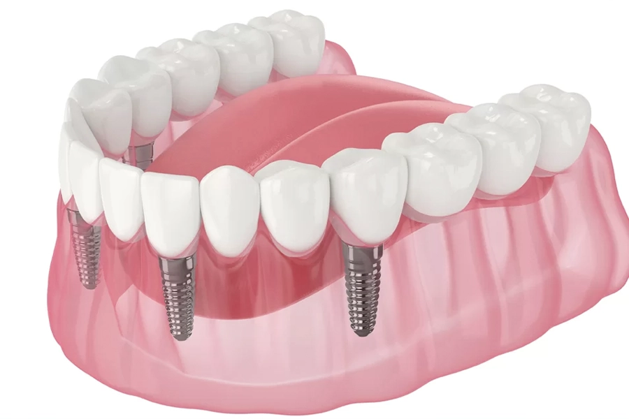 All-on-4 dental implant illustration