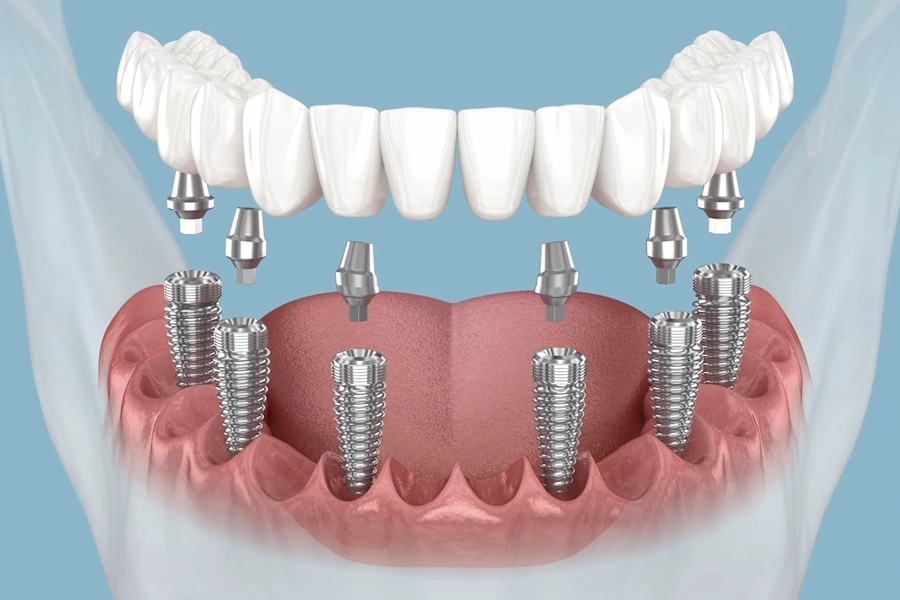 All-on-6 dental implants full mouth fixed teeth at Sundent Dental Clinic Antalya Turkey