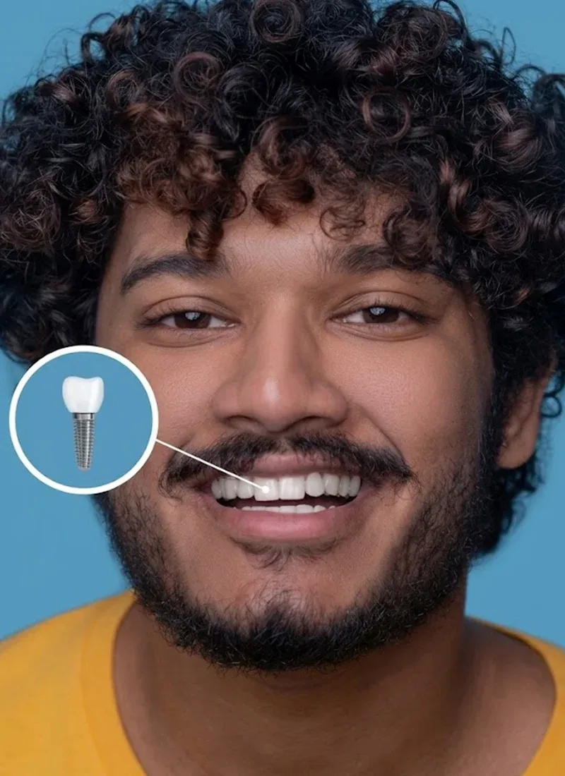 Dental Implants