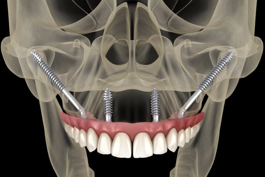 Zygomatic implant surgery for severe bone loss patients at Sundent Dental Clinic Antalya